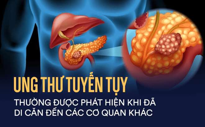 Ung thư tuyḗn tuỵ - ‘Vua’ của các loại ung thư quái ác nhất – có thể bắt nguṑn từ 3 loại thực phẩm trong tủ lạnh nhà bạn- Ảnh 1.