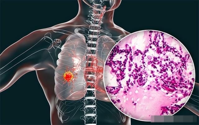 Trước hết, cần phải làm rõ rằng các vấn đề về phổi không xuất phát từ một nguyên nhân đơn lẻ, mà là kết quả của quá trình tích lũy lâu dài từ nhiều yếu tố khác nhau. 