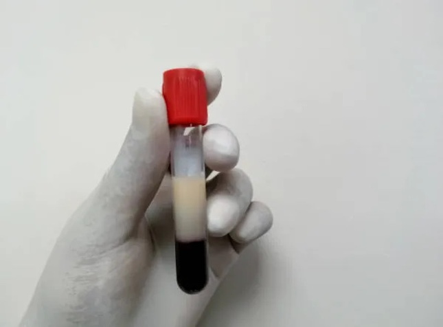 Người đàn ông 28 tuổi máu ngập mỡ, nhớt như dầu: Tất cả tại 2 món khoái khẩu và 2 loại nước “vạn người mê”